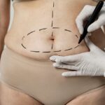Tummy Tuck in Houston