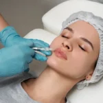 lip lift vs. lip fillers