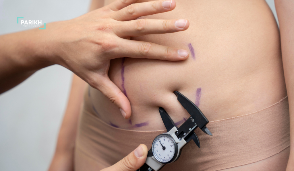 Gynecomastia Surgery in Houston