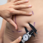 Gynecomastia Surgery in Houston