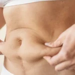 360 liposuction Houston