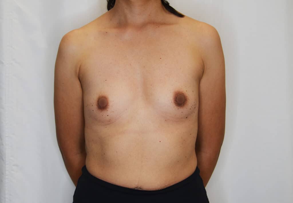 Before Image: Breast Augmentation - front