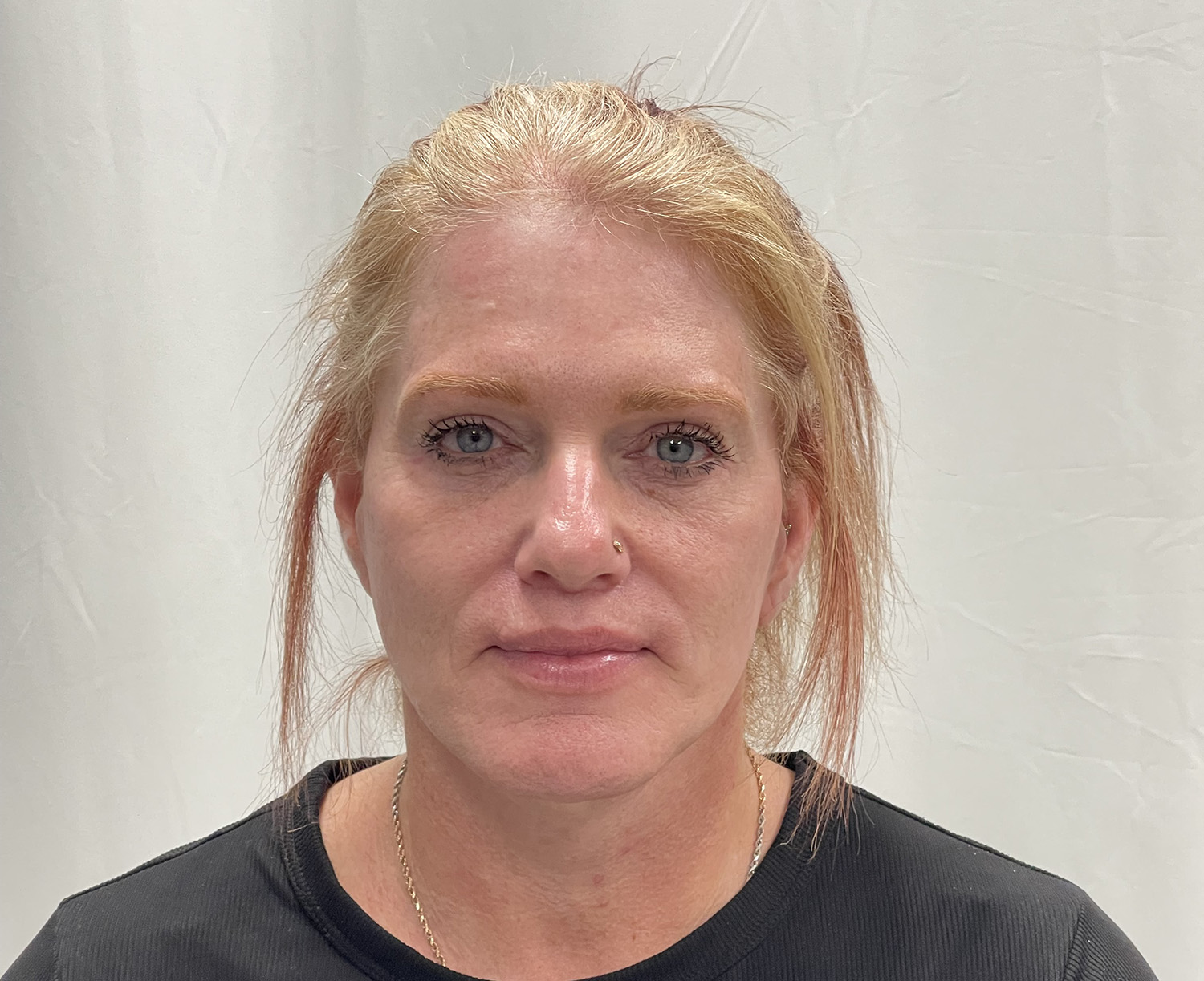 After Image: Lip lift, Quad Blepharoplasty - front