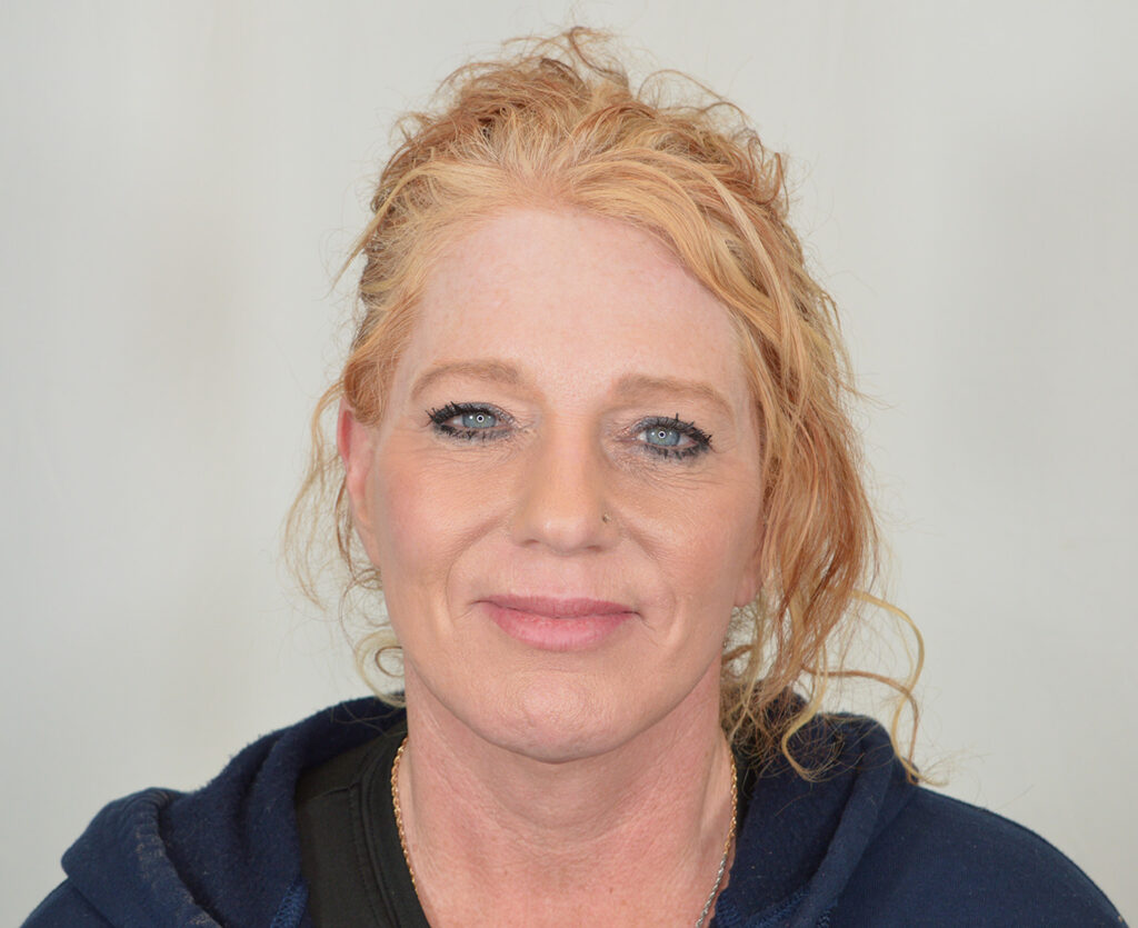 Before Image: Lip lift, Quad Blepharoplasty - front