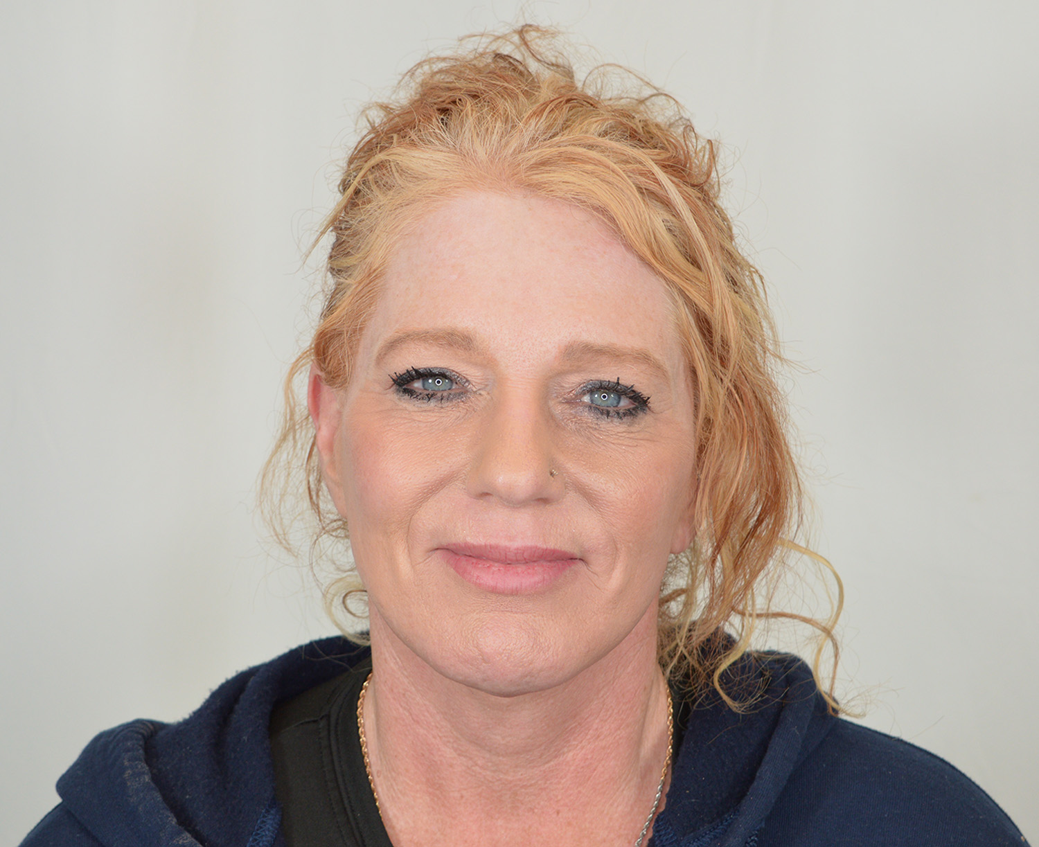 Before Image: Lip lift, Quad Blepharoplasty - front