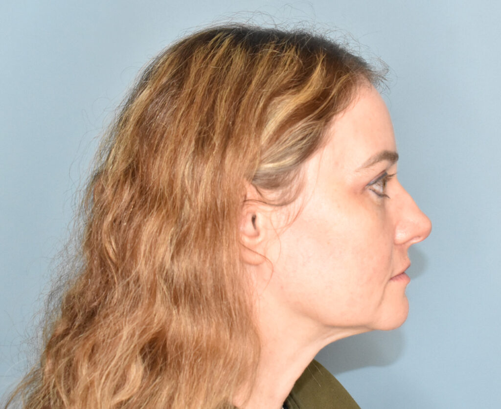 After Image: Lower Blepharoplasty, Full Face Fat Grafting - right-side