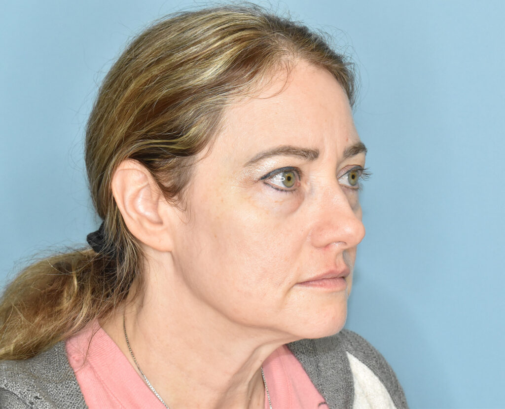 Before Image: Lower Blepharoplasty, Full Face Fat Grafting - right-front-oblique
