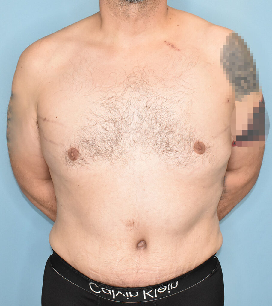 After Image: Male Tummy Tuck, Gynecomastia - front