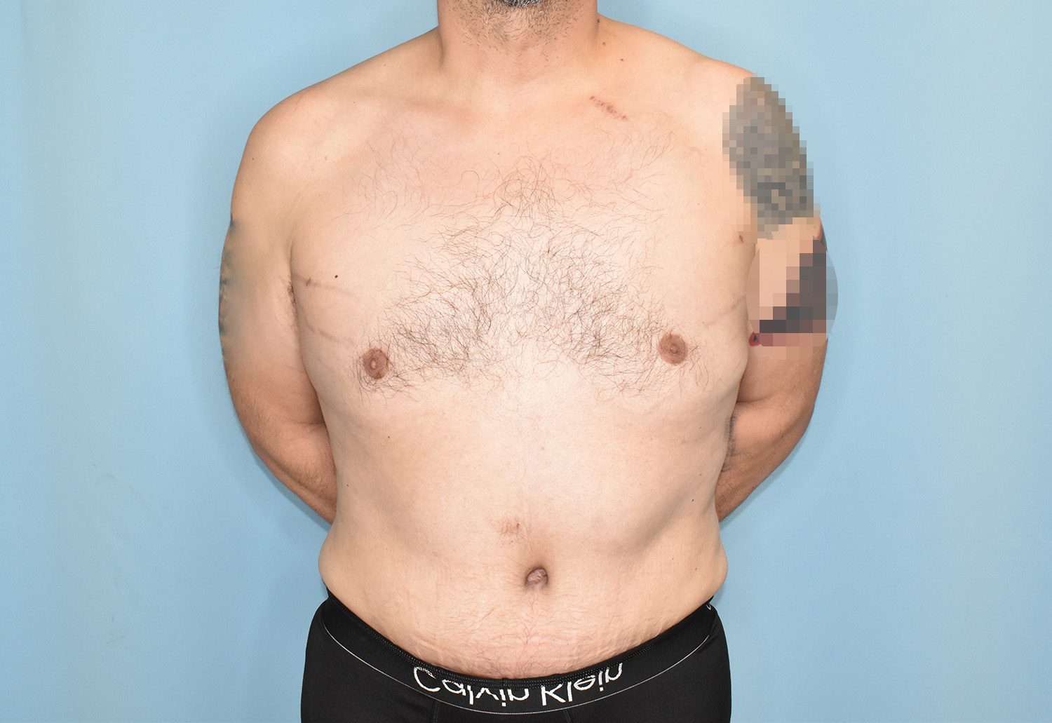 After Image: Male Tummy Tuck, Gynecomastia - front