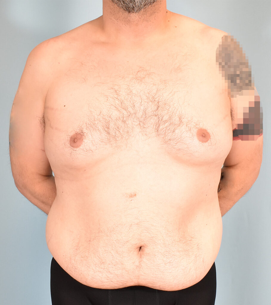 Before Image: Male Tummy Tuck, Gynecomastia - front