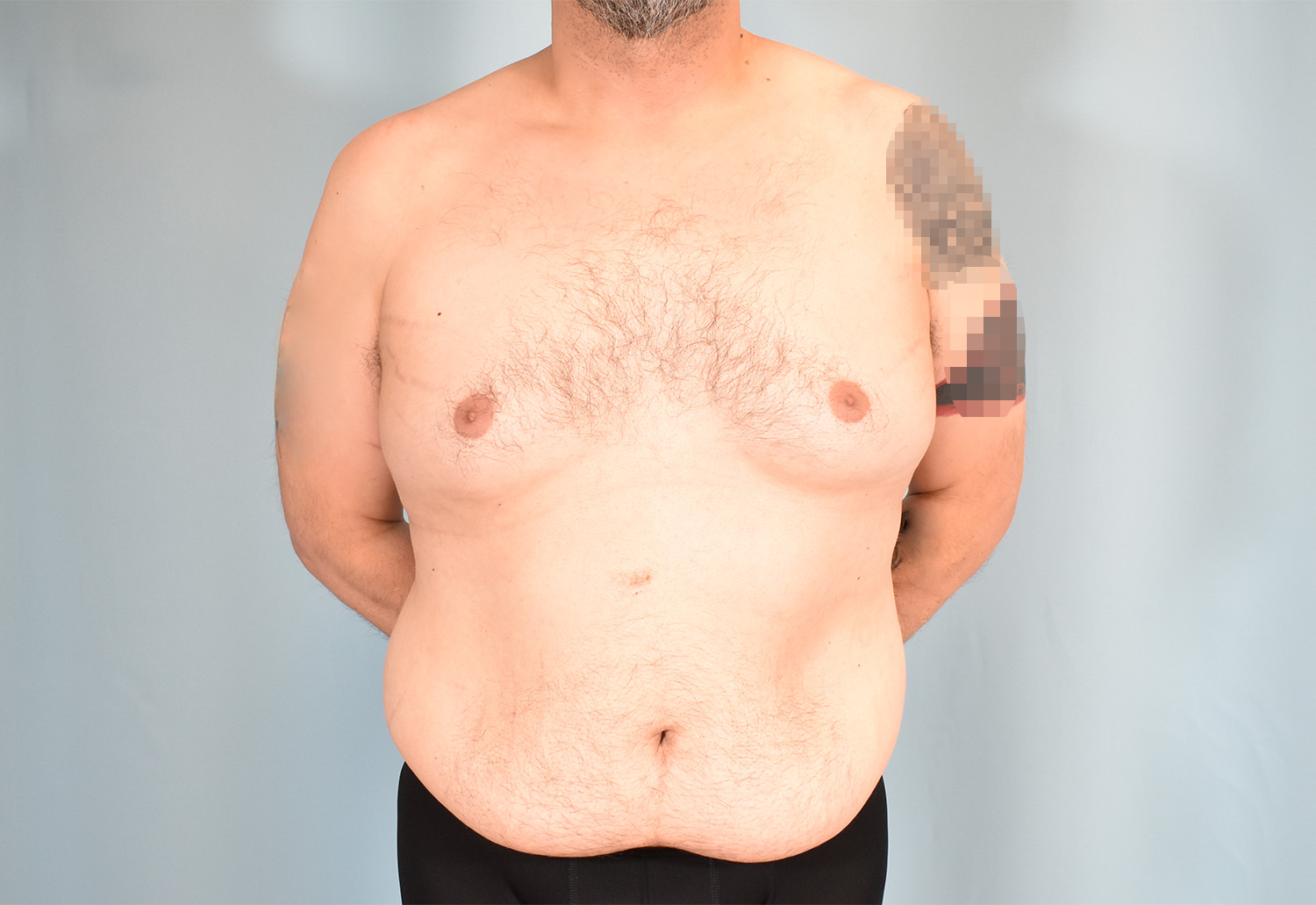 Before Image: Male Tummy Tuck, Gynecomastia - front