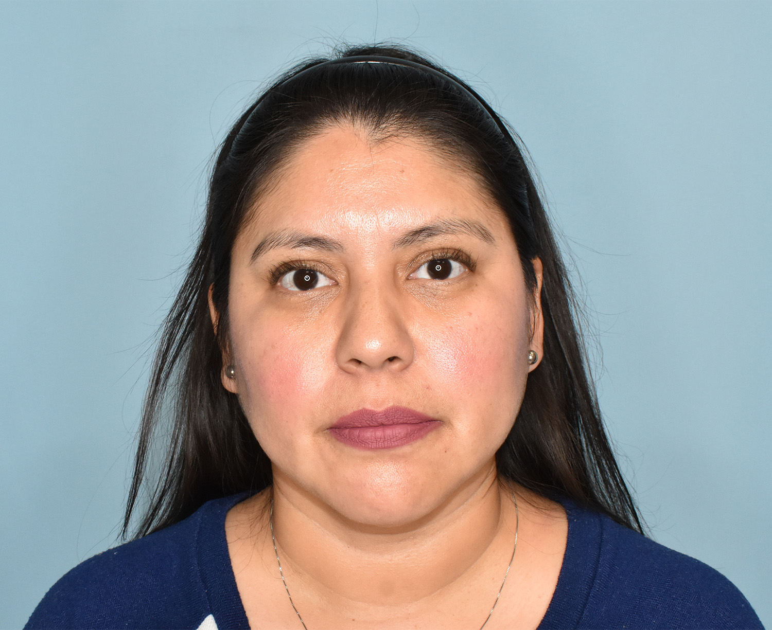 After Image: Submental Liposuction, Renuvion - front