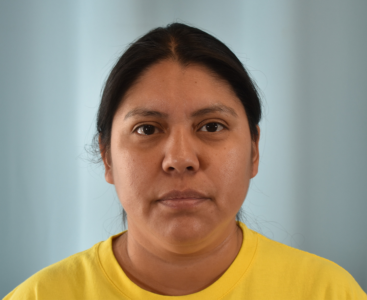 Before Image: Submental Liposuction, Renuvion - front