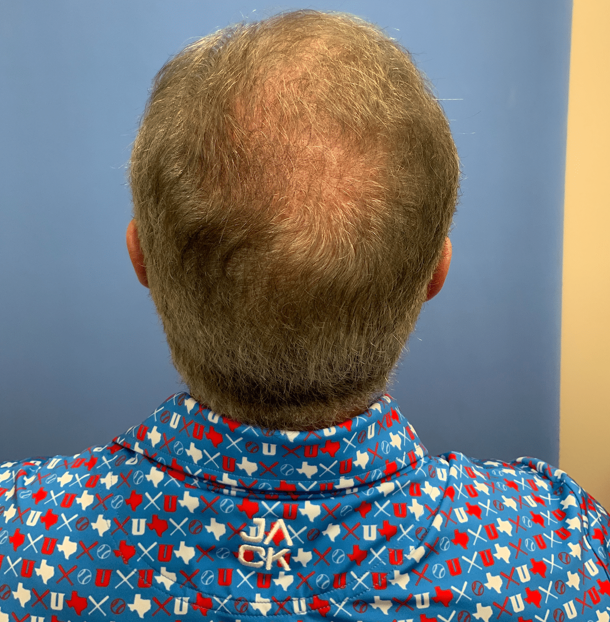 After Image: FoLix Hair Laser Treatment - back