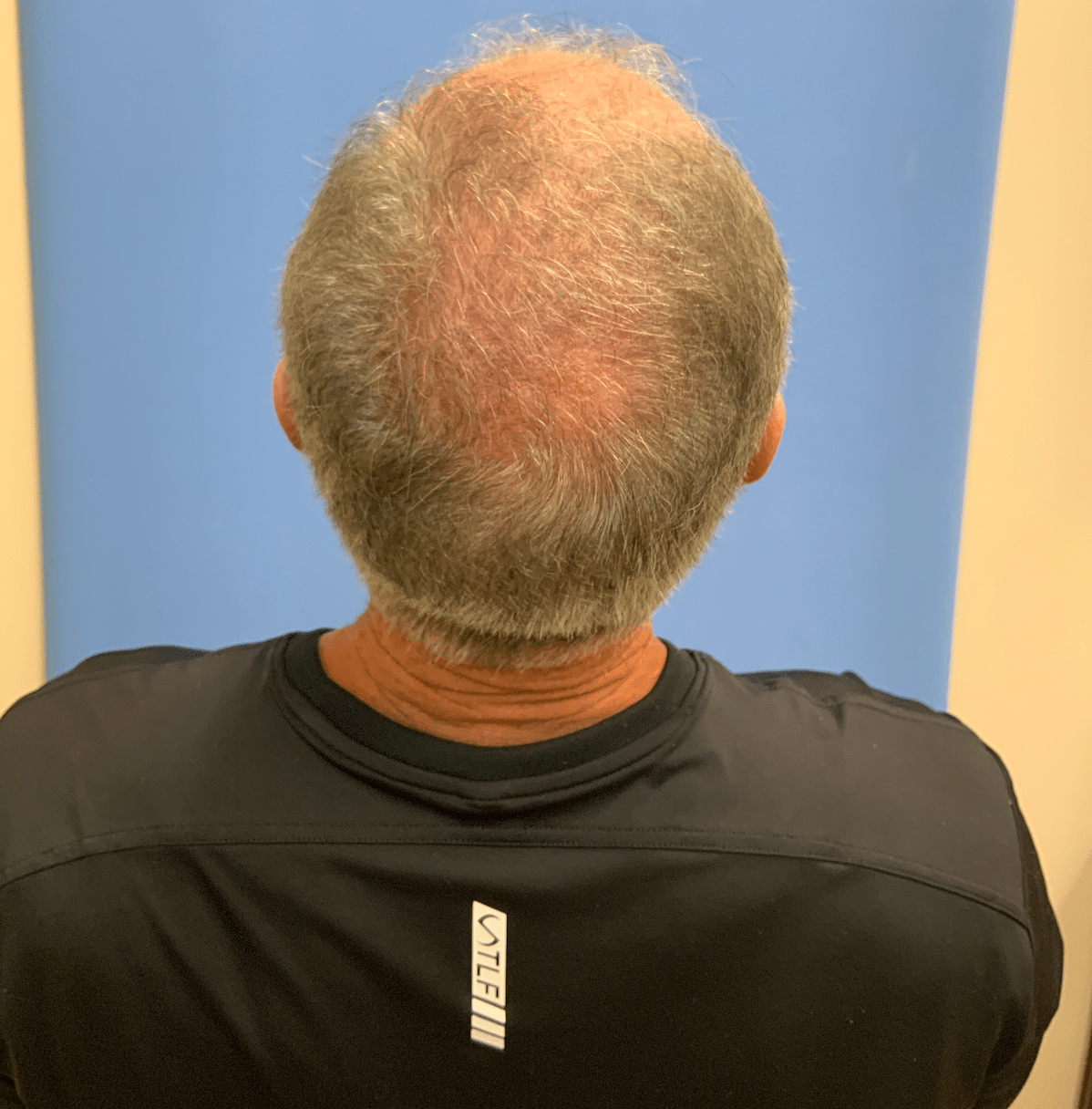 Before Image: FoLix Hair Laser Treatment - back