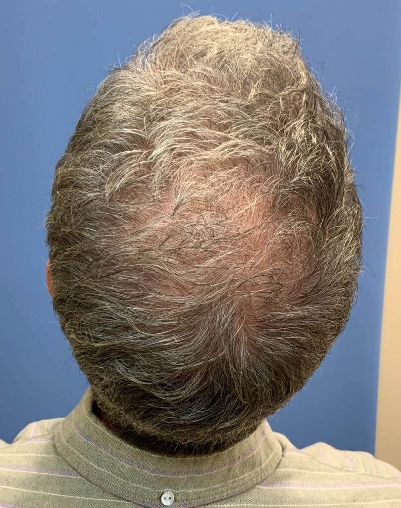 After Image: FoLix Hair Laser Treatment - back