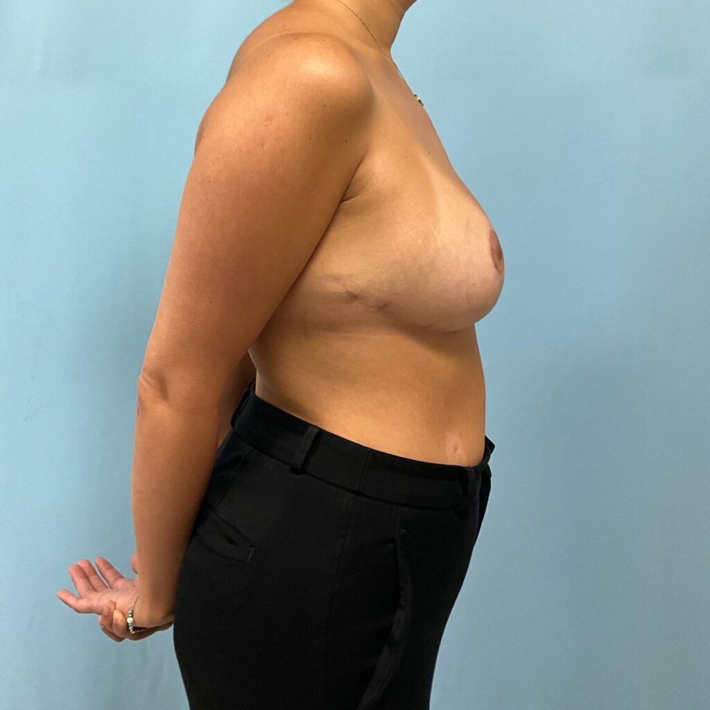 After Image: Breast Augmentation - right-side