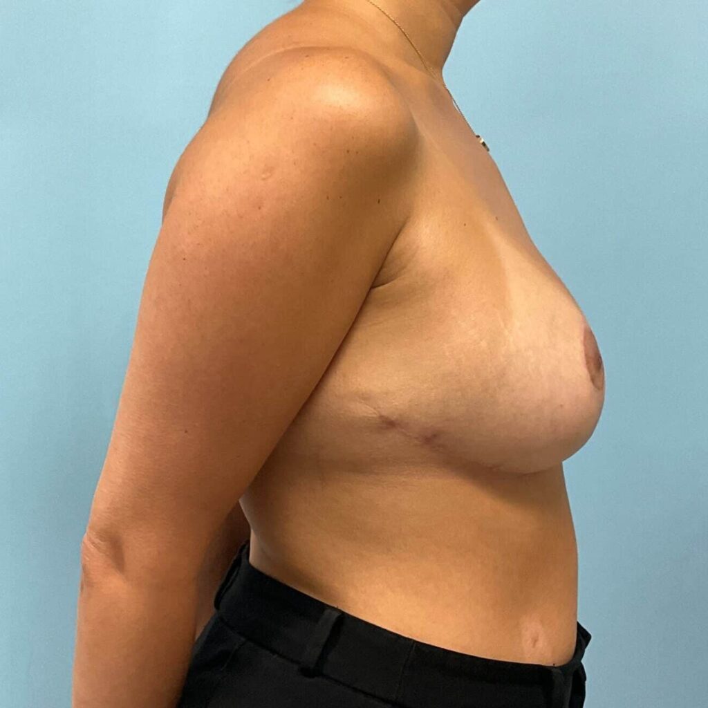 After Image: Breast Augmentation - right-side