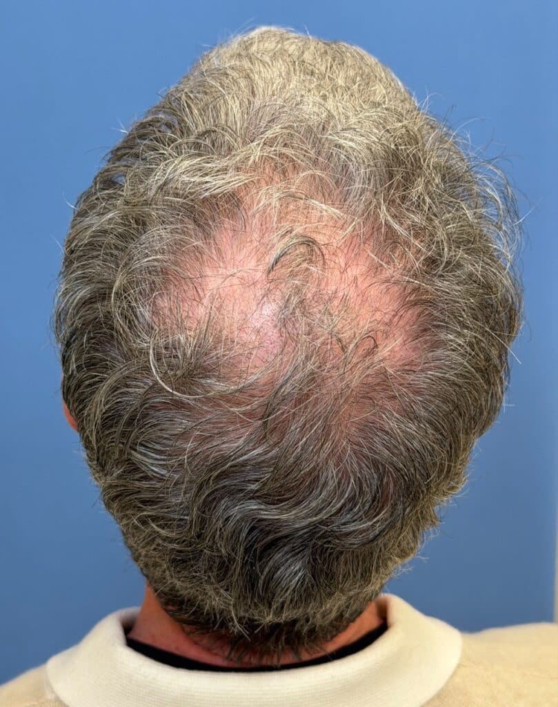 Before Image: FoLix Hair Laser Treatment - back