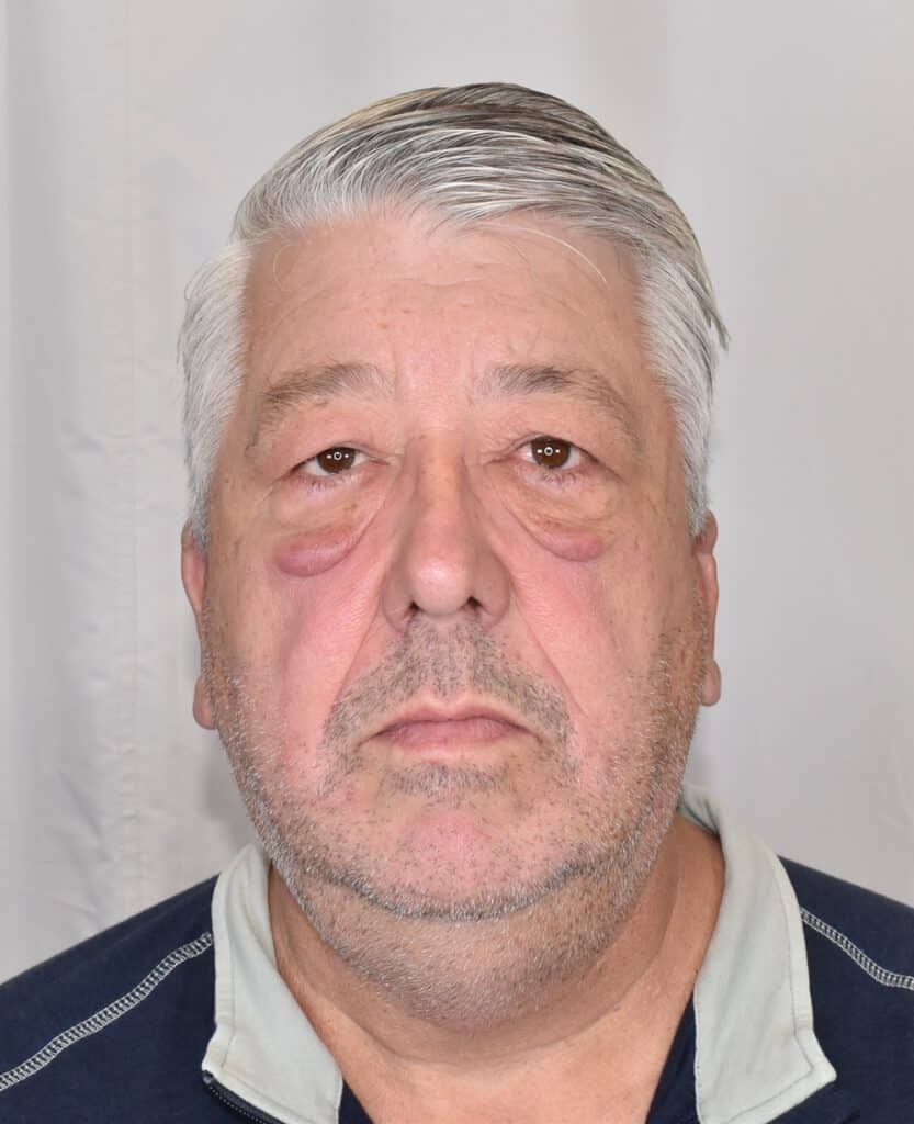 Before Image: Lower Blepharoplasty - front