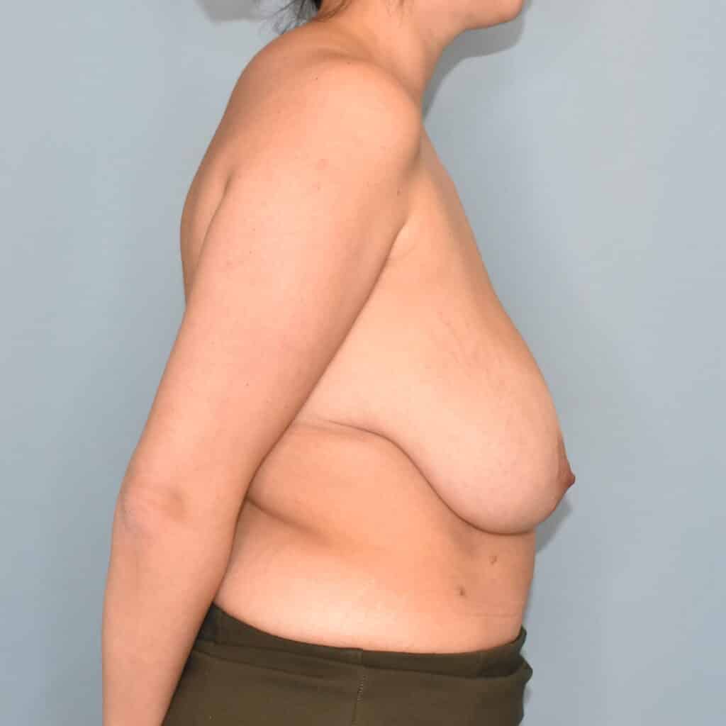 Before Image: Breast Augmentation - right-side
