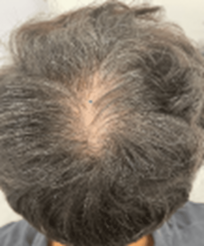 Before Image: FoLix Hair Laser Treatment - front