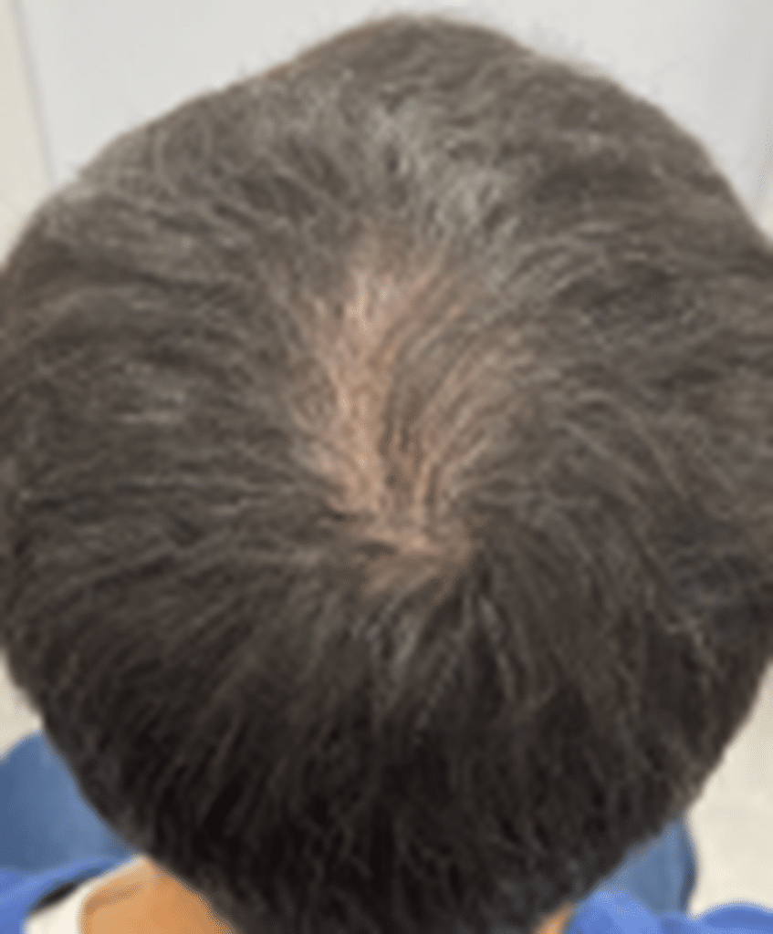 After Image: FoLix Hair Laser Treatment - front