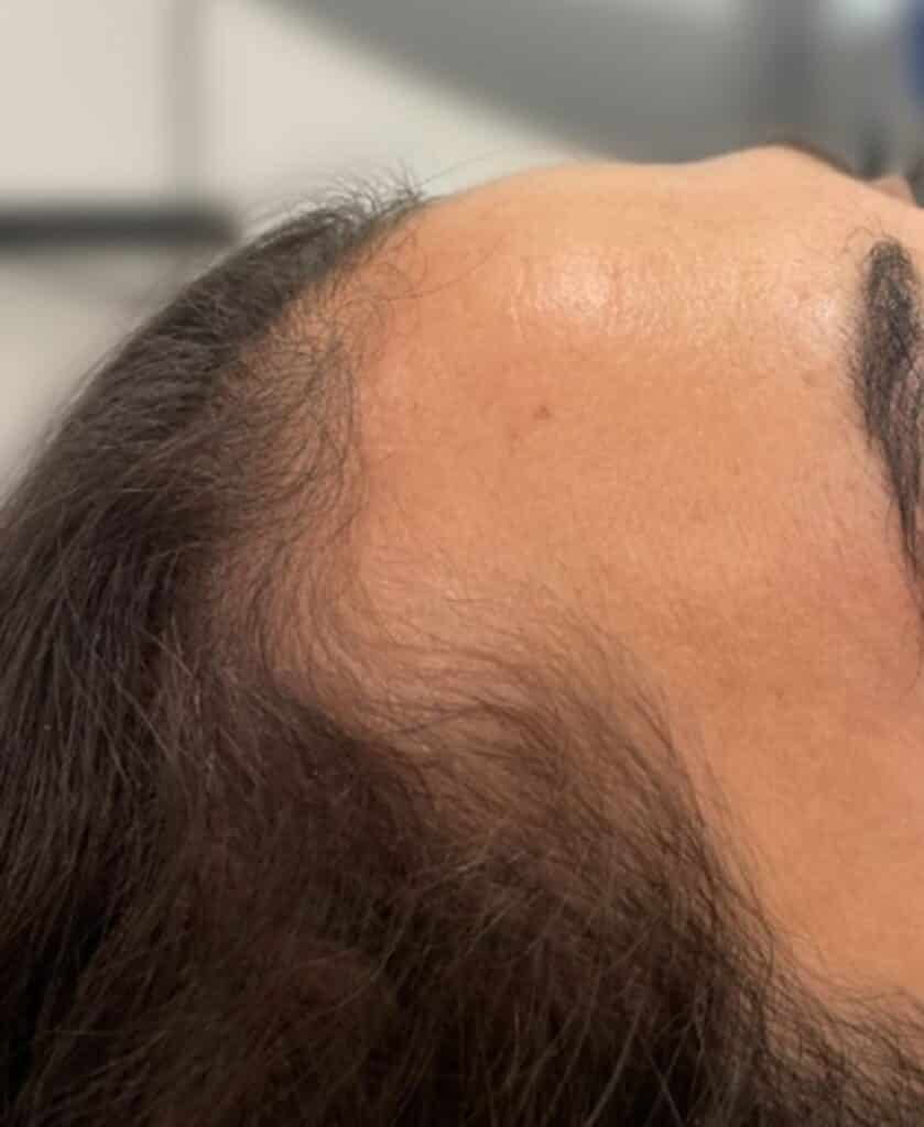 Before Image: FoLix Hair Laser Treatment - right-side