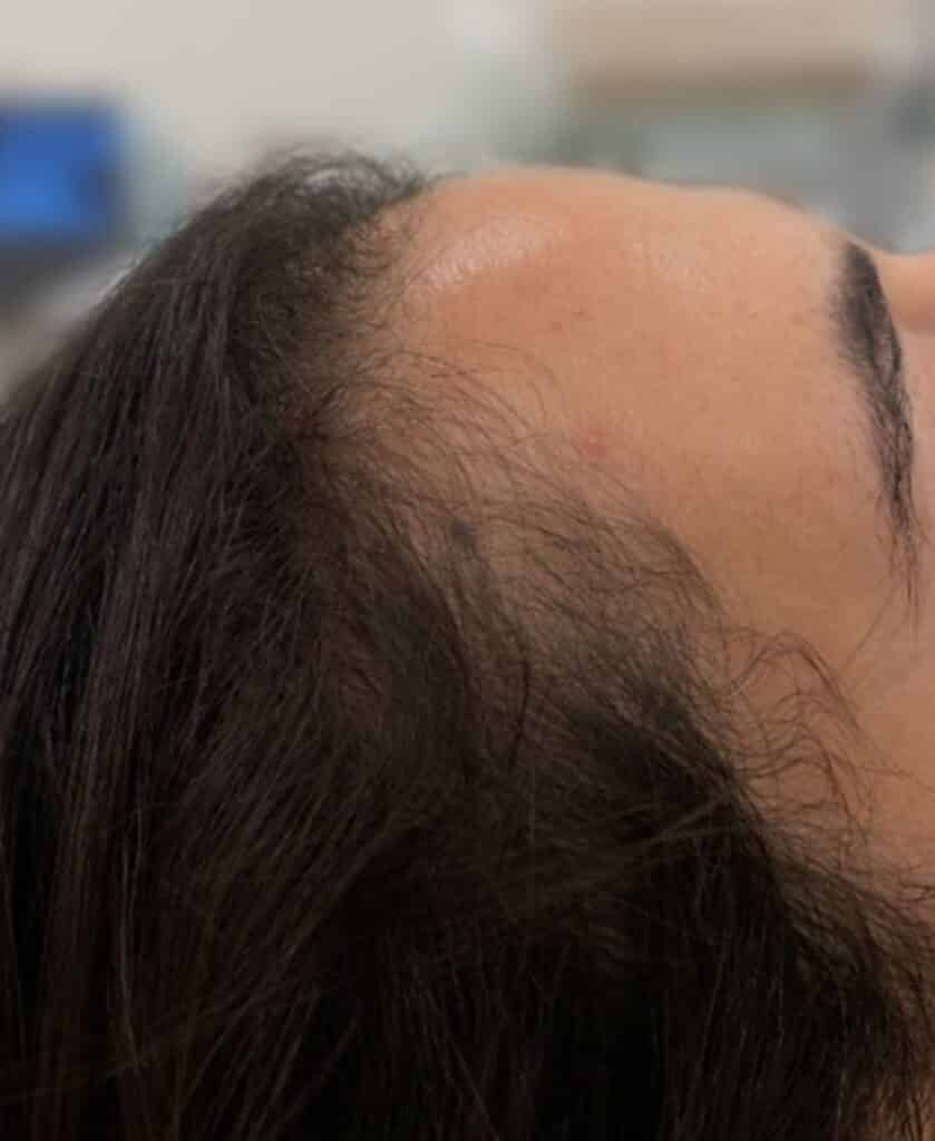 After Image: FoLix Hair Laser Treatment - right-side