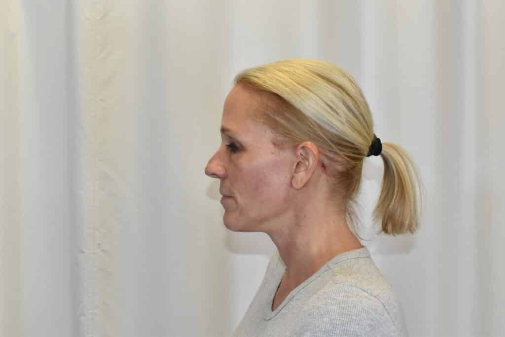 After Image: Facelift - left-side