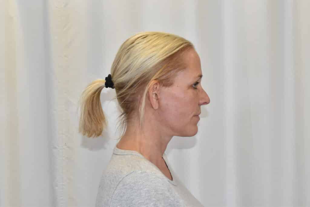 After Image: Facelift - right-side