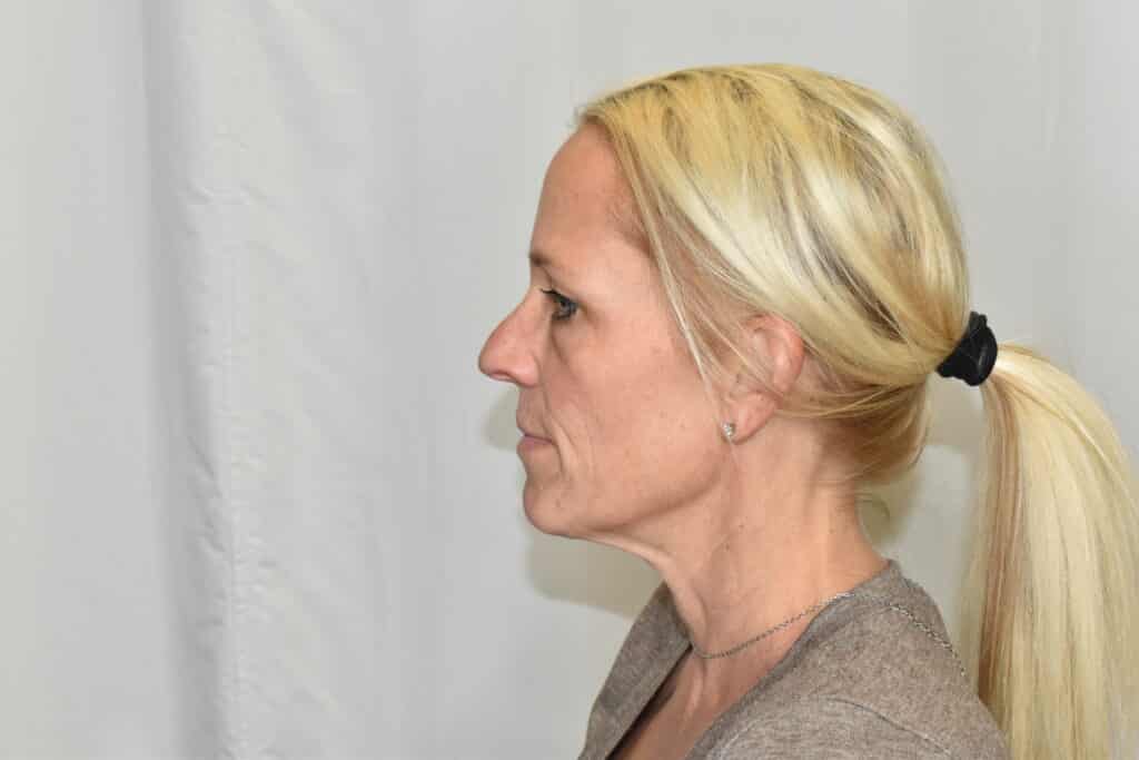 Before Image: Facelift - left-side