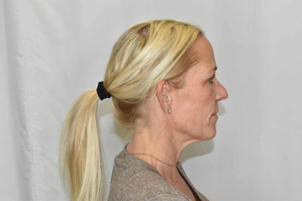 Before Image: Facelift - right-side