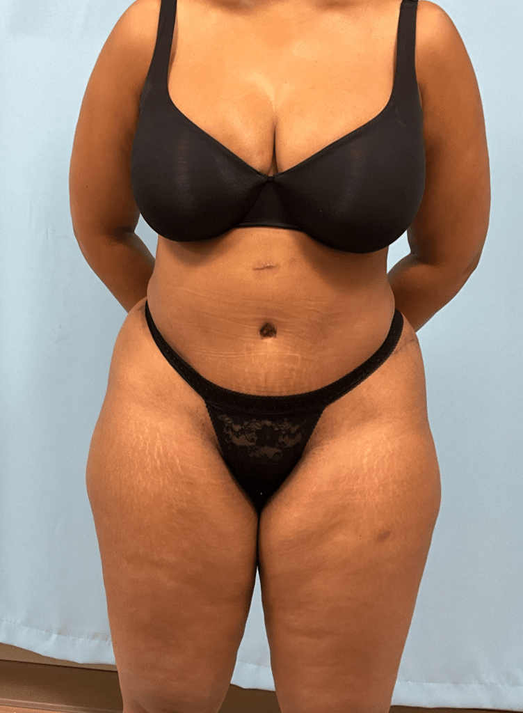 After Image: Tummy Tuck - front