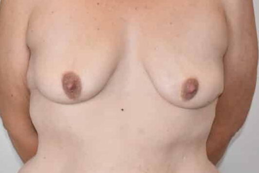 Before Image: Breast Augmentation - front