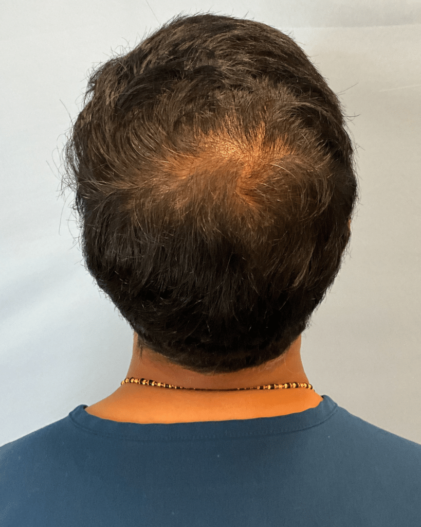 After Image: FoLix Hair Laser Treatment - back