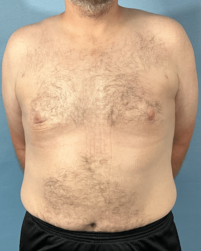 After Image: VASER liposuction of chest with Renuvion - front