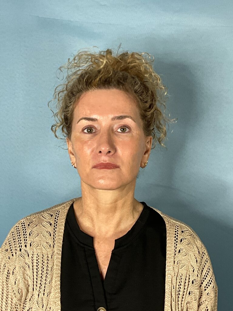After Image: Full face rejuvenation - front
