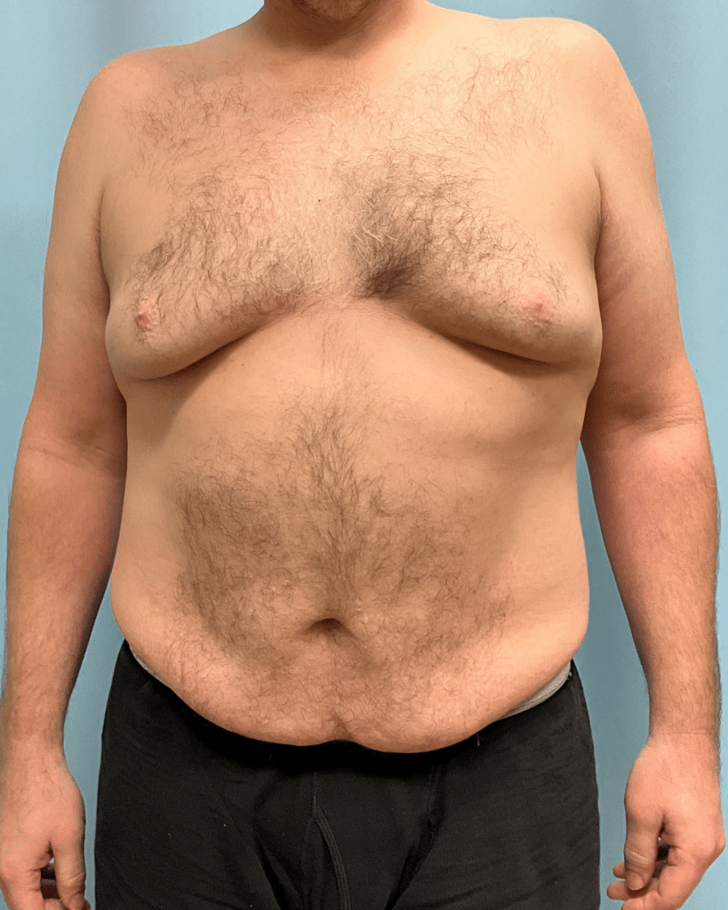 Before Image: VASER liposuction of chest with Renuvion - front