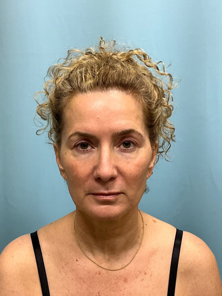 Before Image: Full face rejuvenation - front