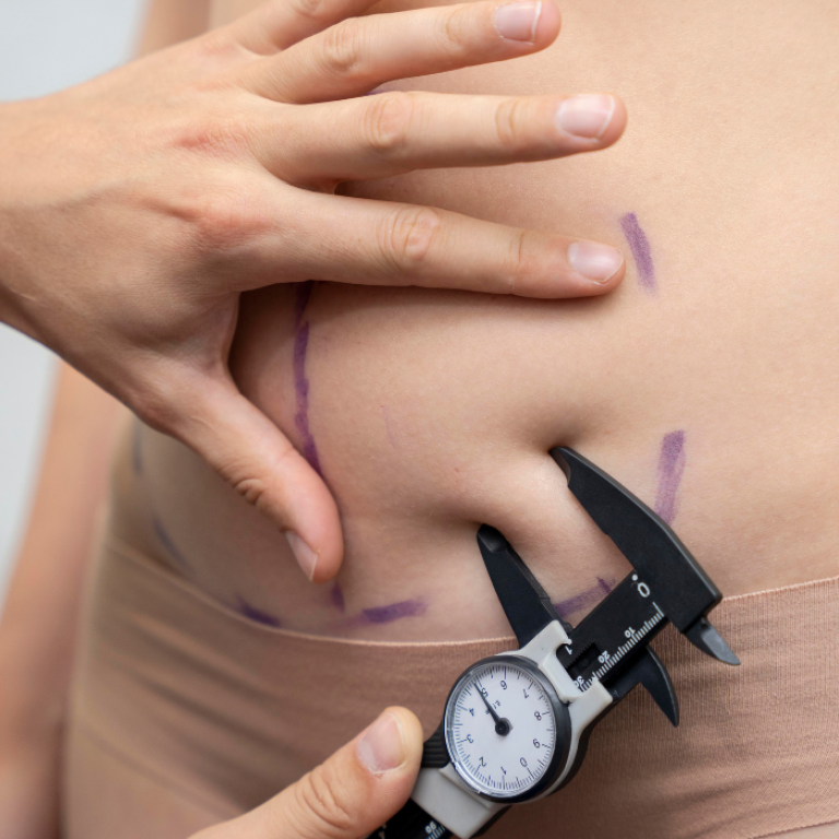 Gynecomastia Surgery in Houston