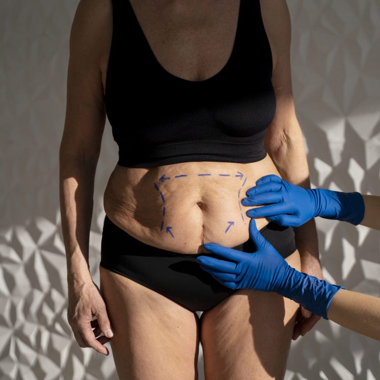 Mommy Makeover in Houston